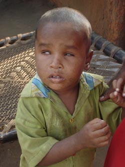 Kaushal Kaul who was born blind in a Giridih village. Residents blame it on industrial pollution.